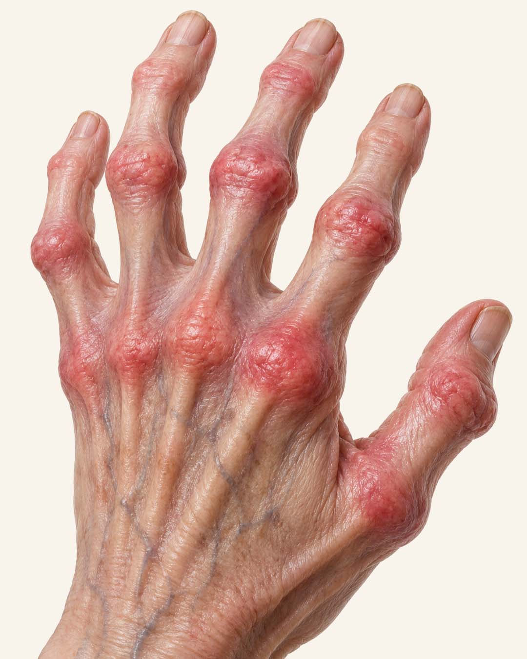 Mãos com sinais de artrite reumatoide